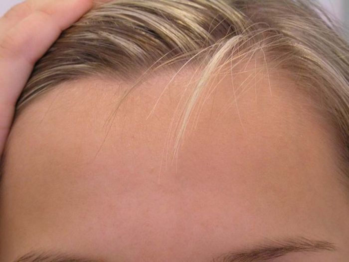 Шрамы от прыщей - удаление